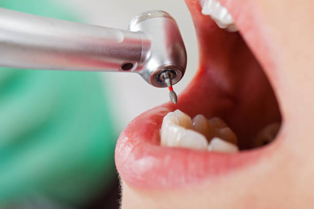 Best Emergency Root Canal Therapy in Fruitvale, CO